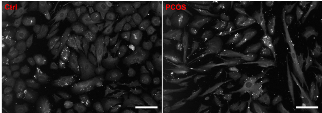 PCOD and PCOS